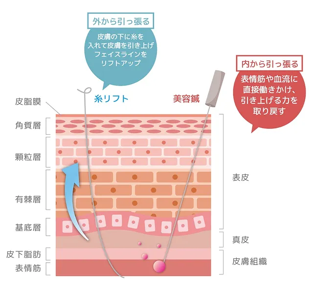 美容鍼と糸リフトの違い