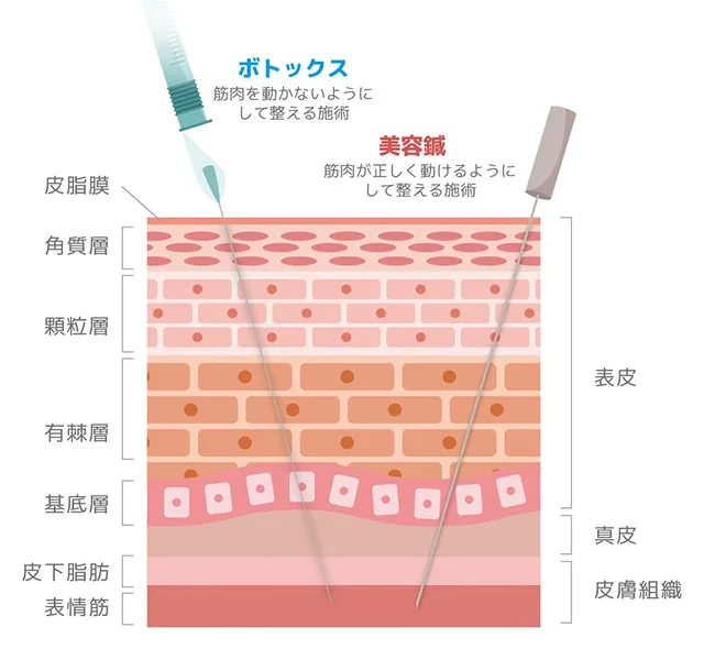 美容鍼とボトックスの違い