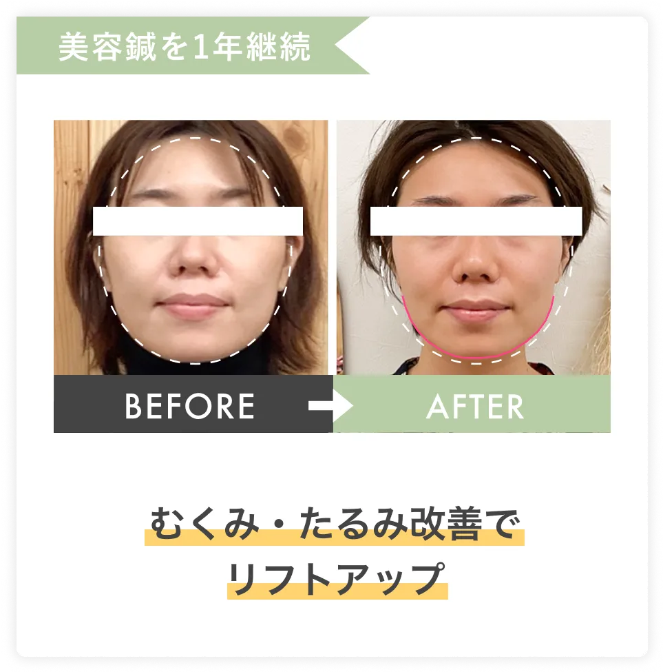 むくみ・たるみ改善でリフトアップ