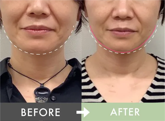 痛みがほとんどなかった！