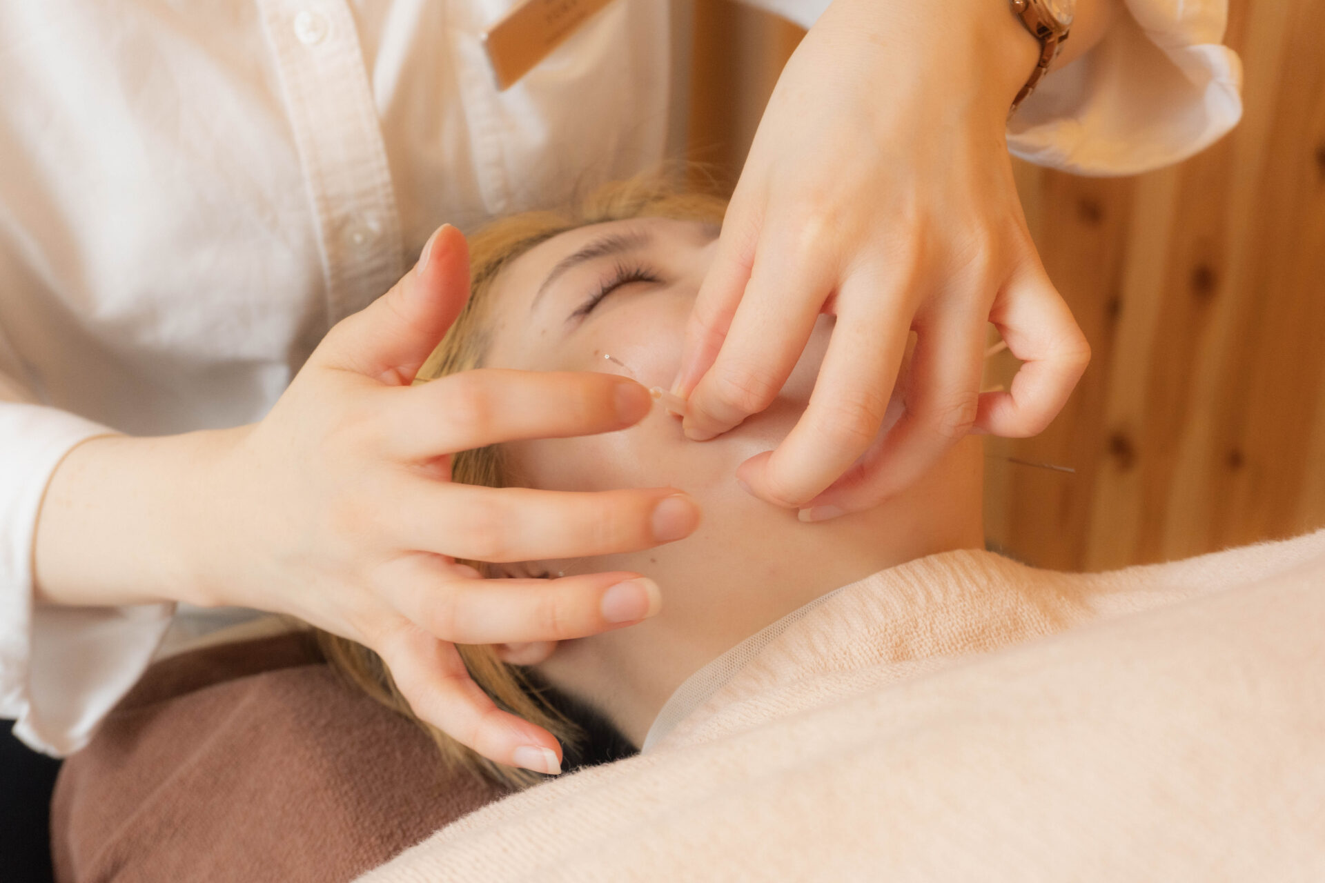 美容鍼の施術の様子